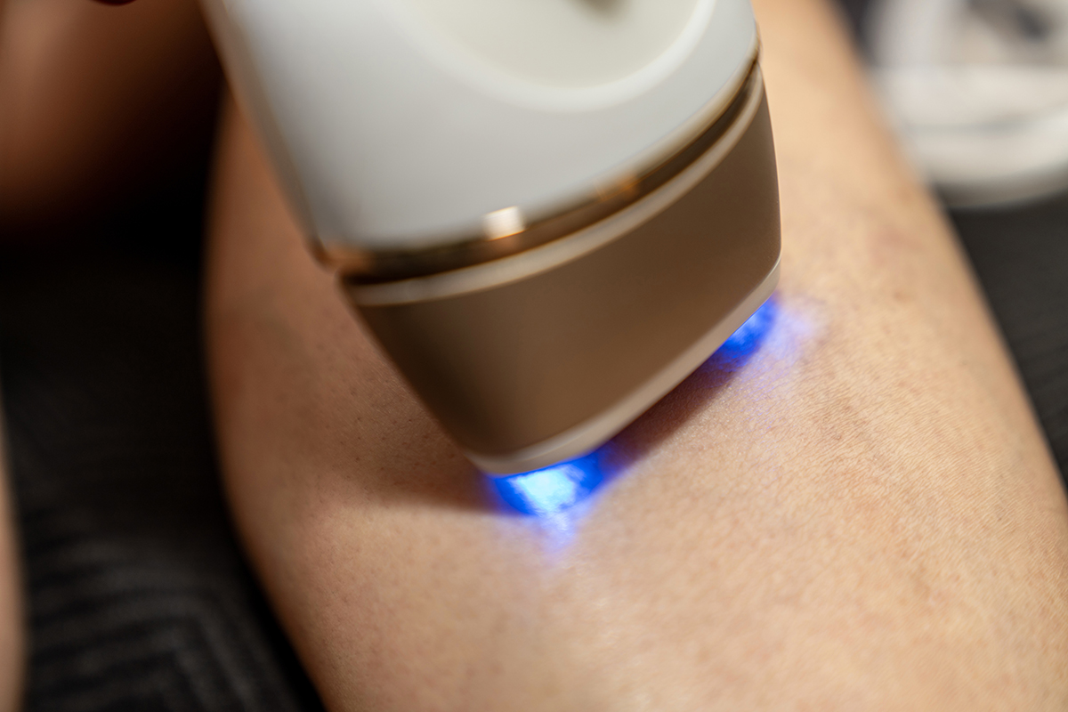 A close-up of a person using an IPL device on their leg