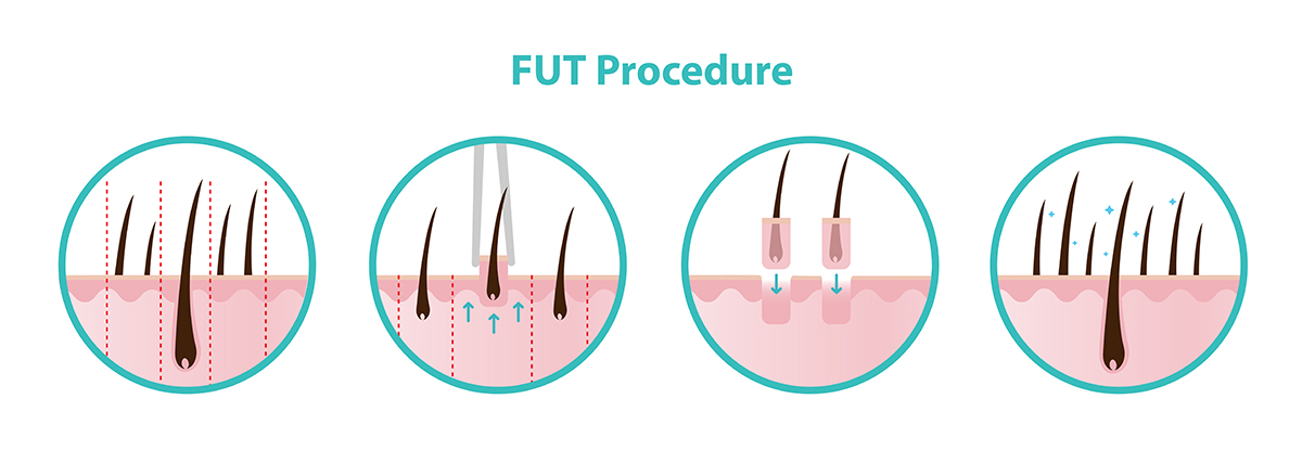 An infographic breaking down the 
FUT hair transplant procedure 