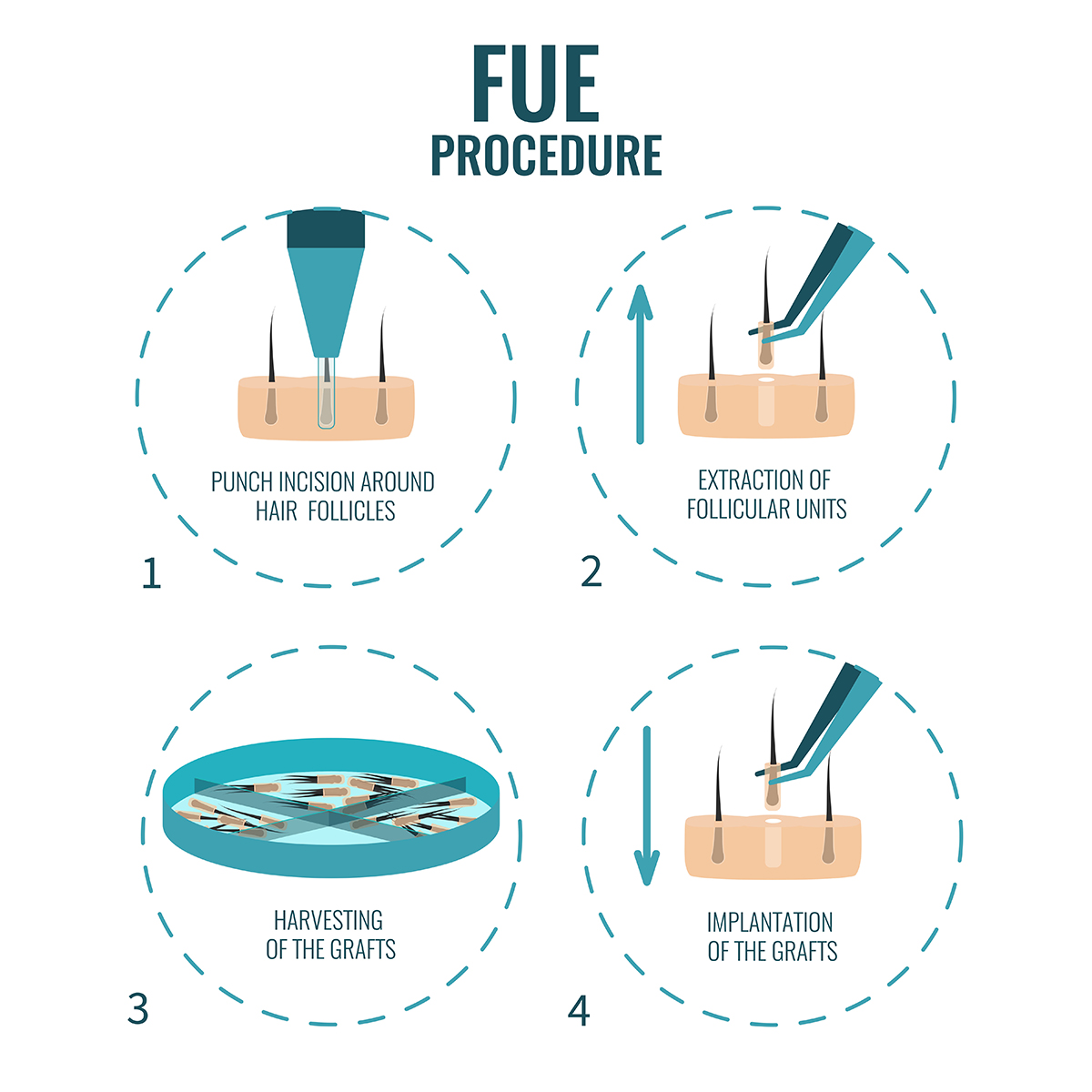 An infographic of follicular unit extraction procedure stages