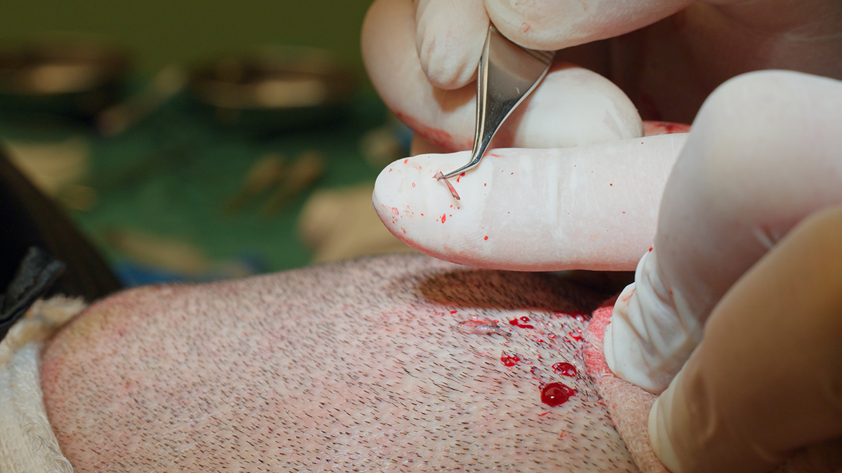 A close-up of a hair transplant