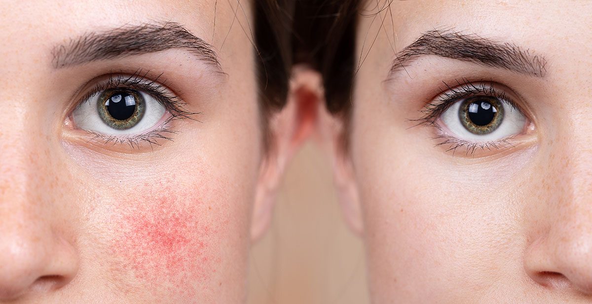 A before-and-after of a woman who has received treatment for rosacea, showing a visible improvement in symptoms