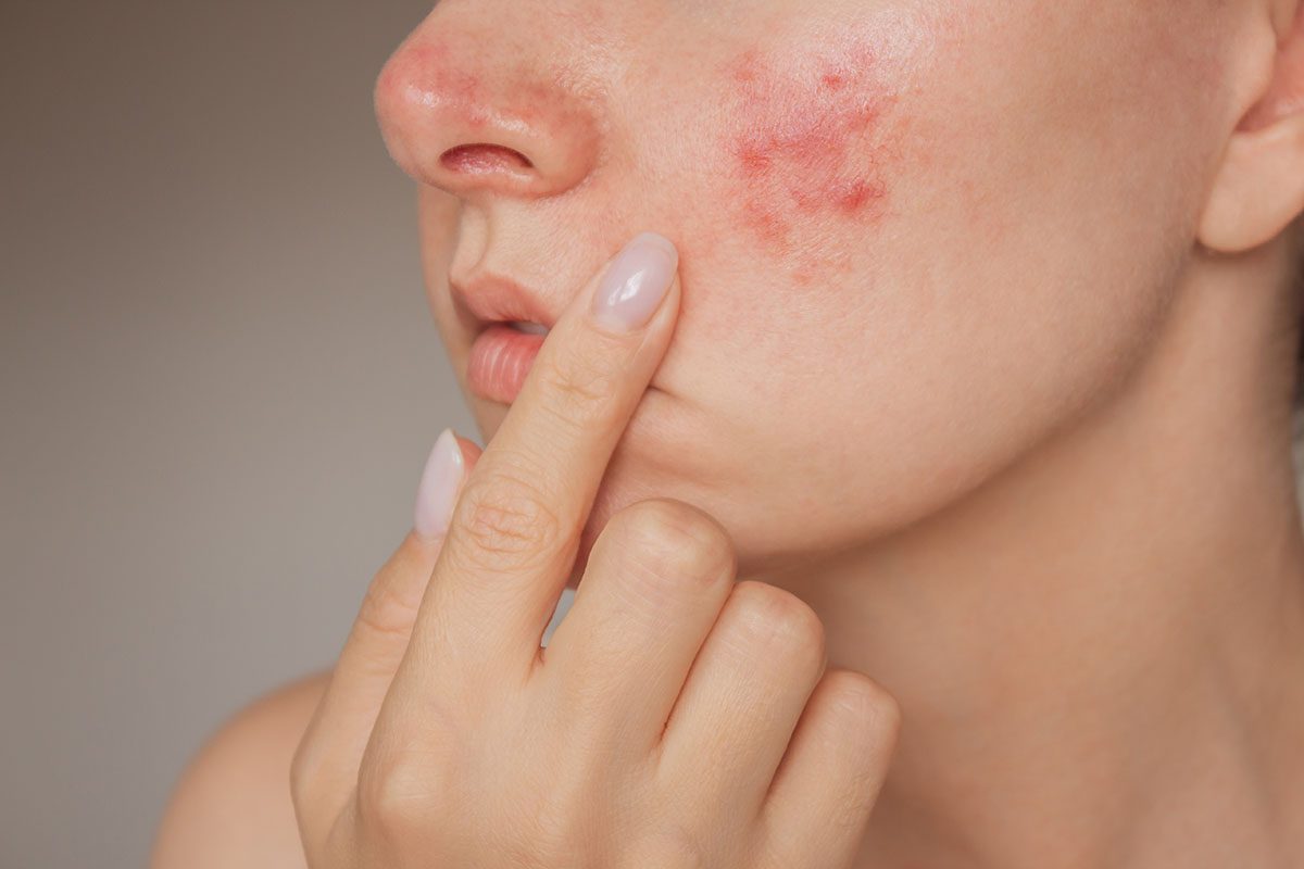 A close-up of a woman with visible rosacea on her cheek