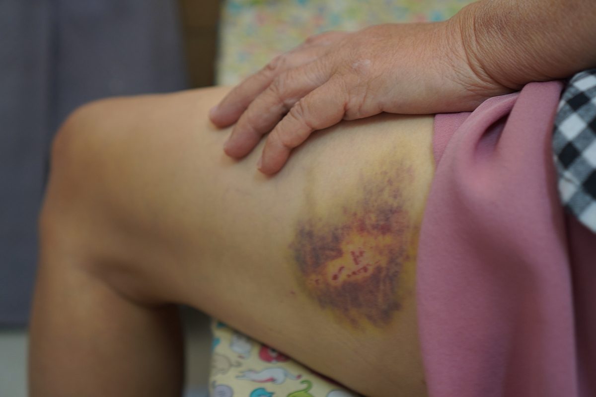 A hematoma bruise on a woman's leg