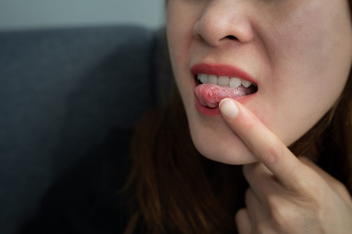 A woman pointing to an ulcer on her tongue