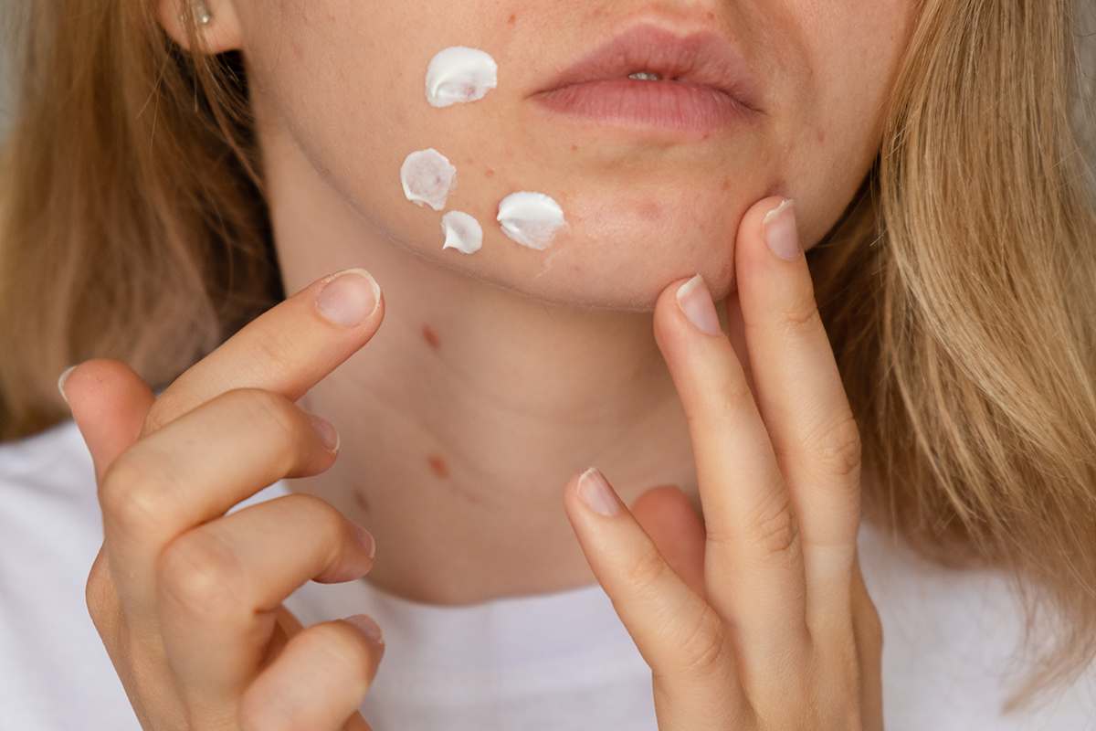 A woman applying spot cream