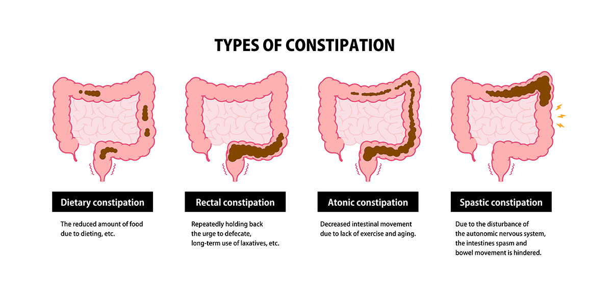 A diagram explaining four causes of constipation