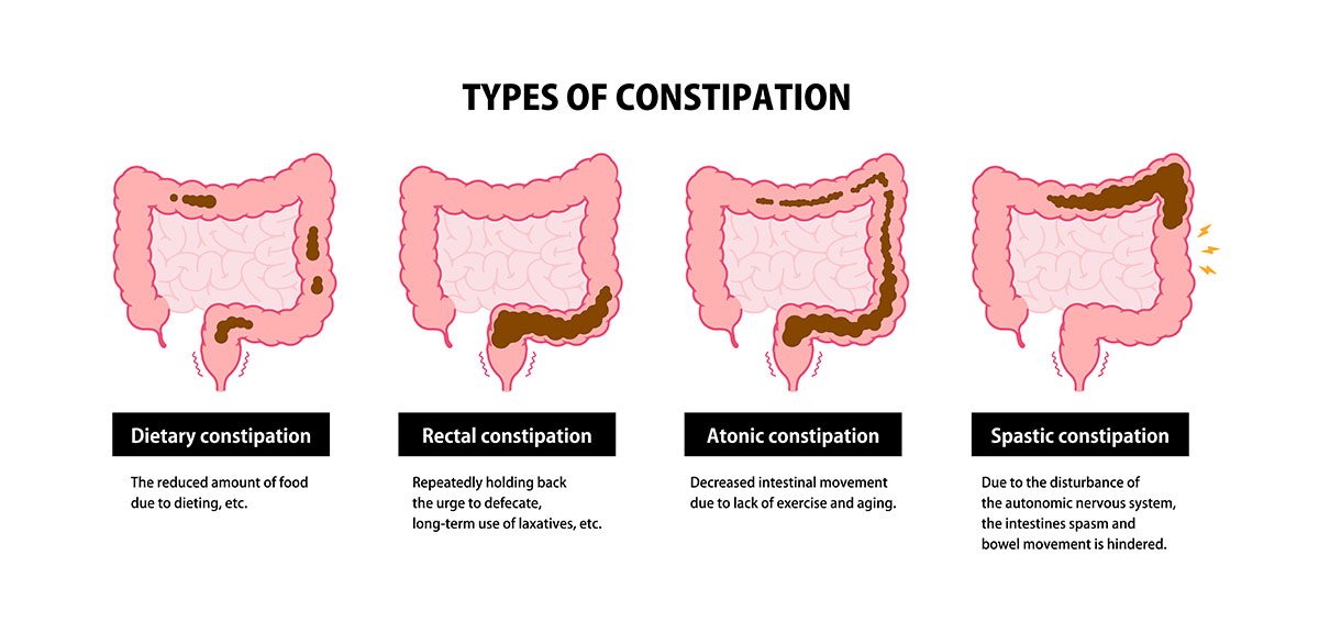 A diagram explaining four causes of constipation