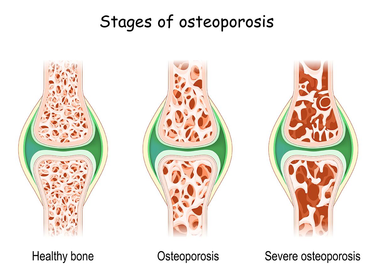 Osteoporosis stages. close-up of human bones with different density. bone disease. aging process. Vector illustration.