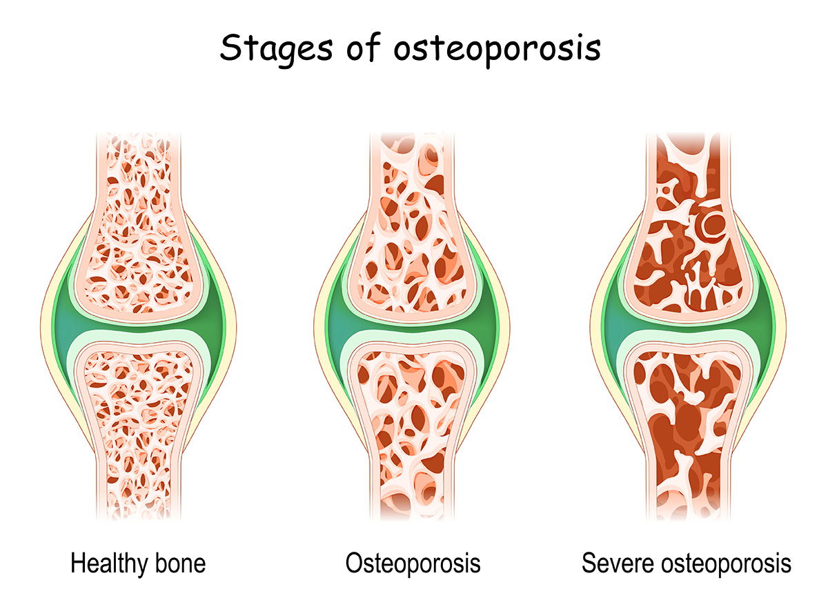 Osteoporosis stages. close-up of human bones with different density. bone disease. aging process. Vector illustration.