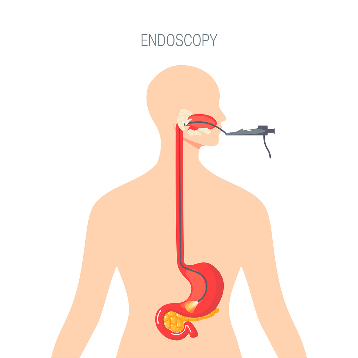A diagram of an endoscopy
