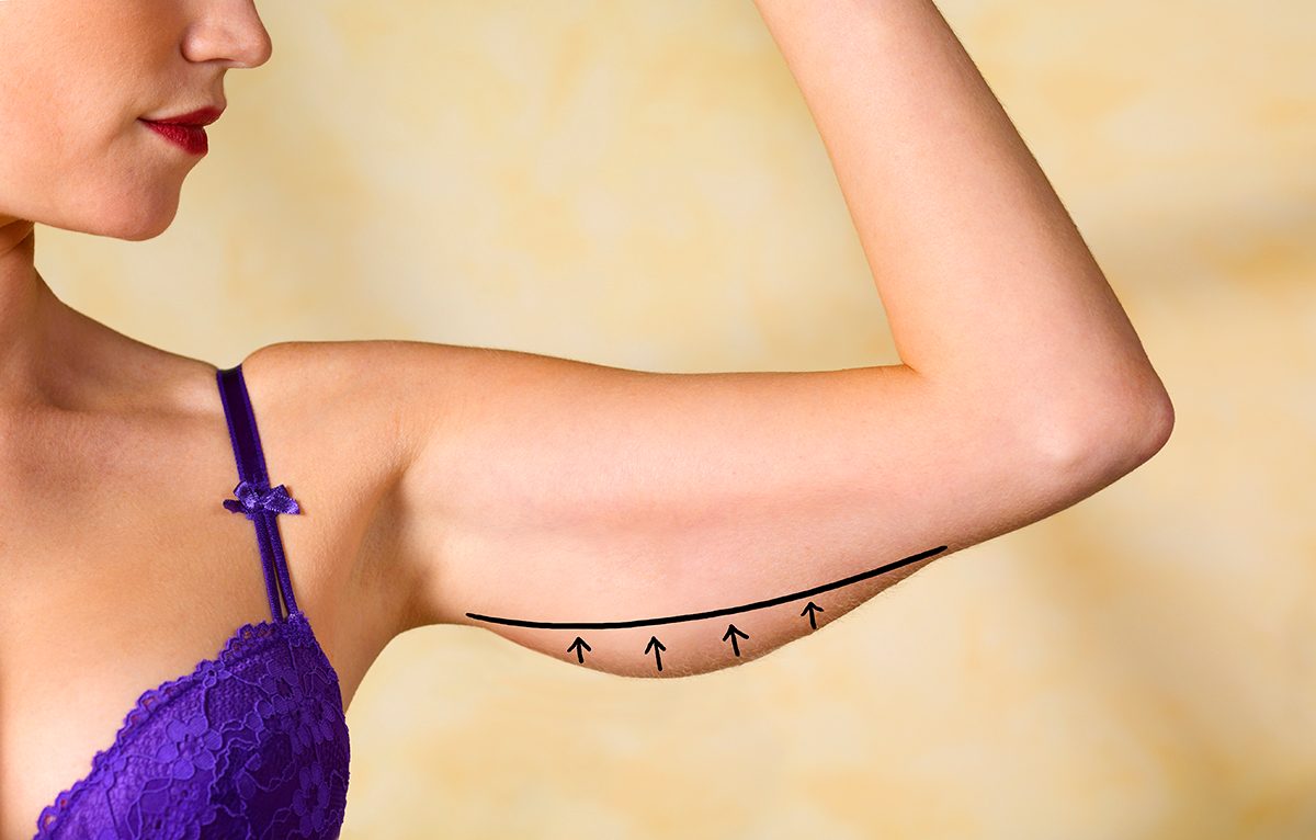 A woman's arm is marked in pen for an arm lift surgery