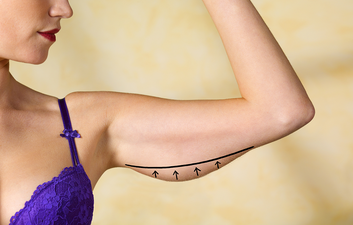A woman's arm is marked in pen for an arm lift surgery